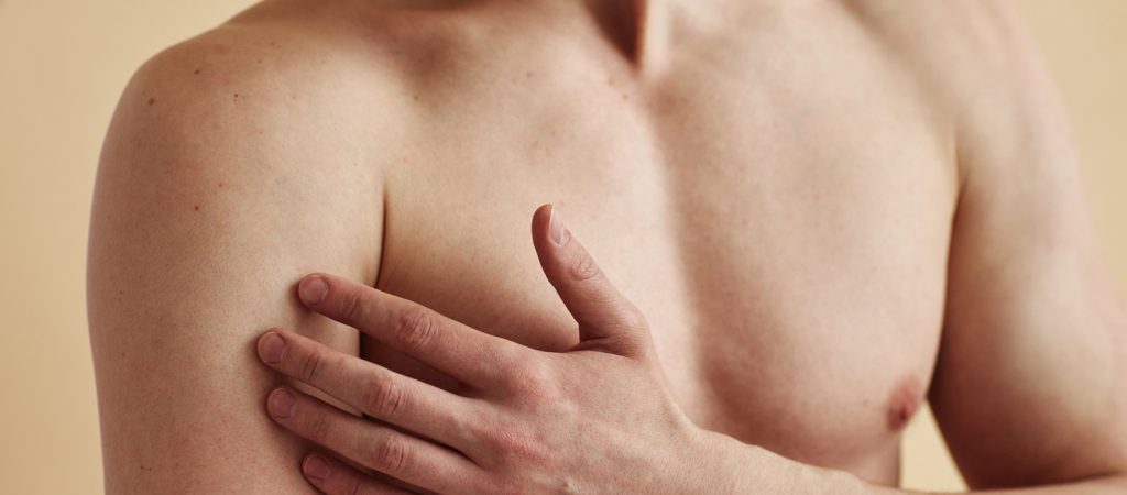Ginecomastia